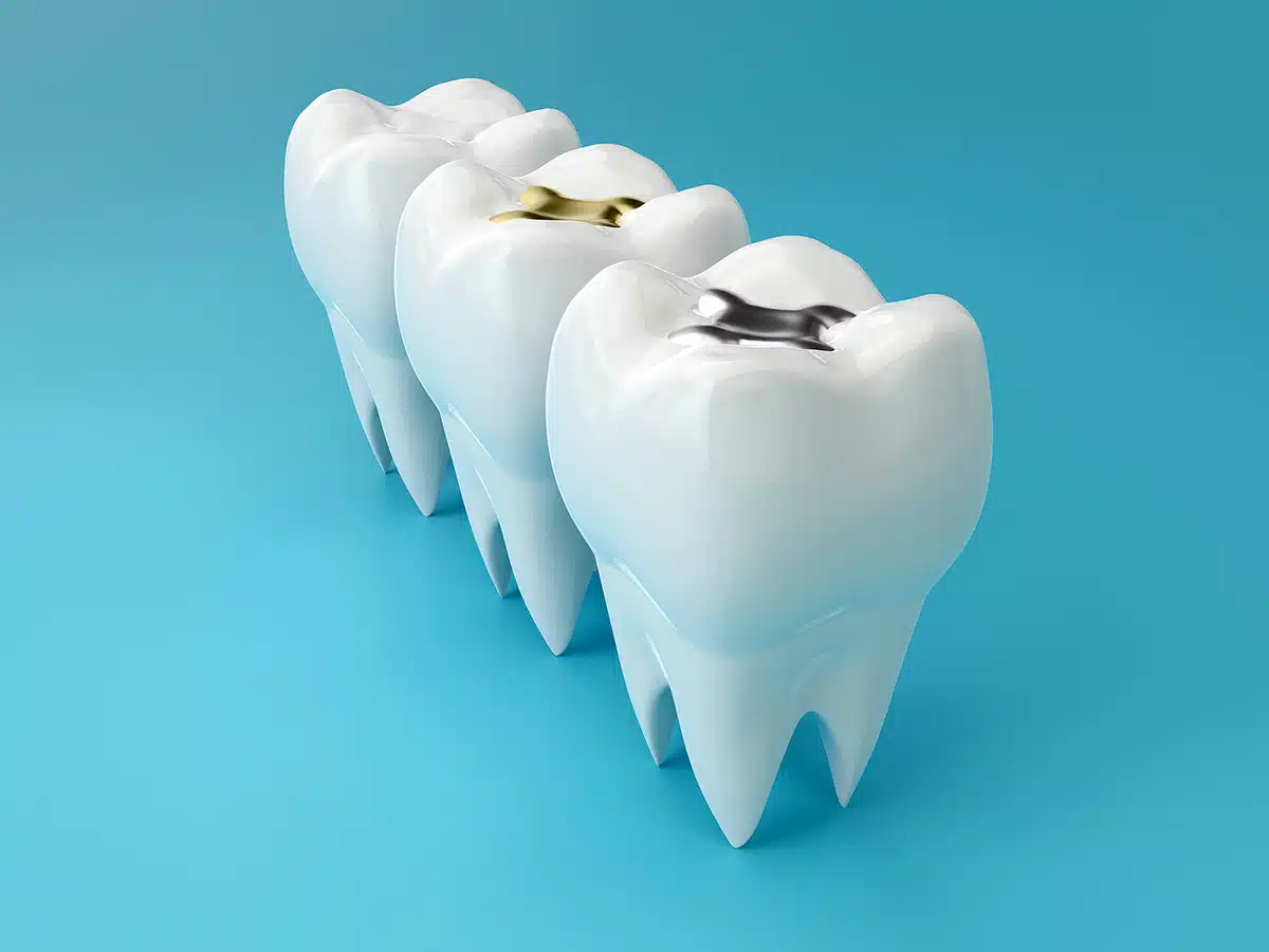 Pediatric Cavity Fillings