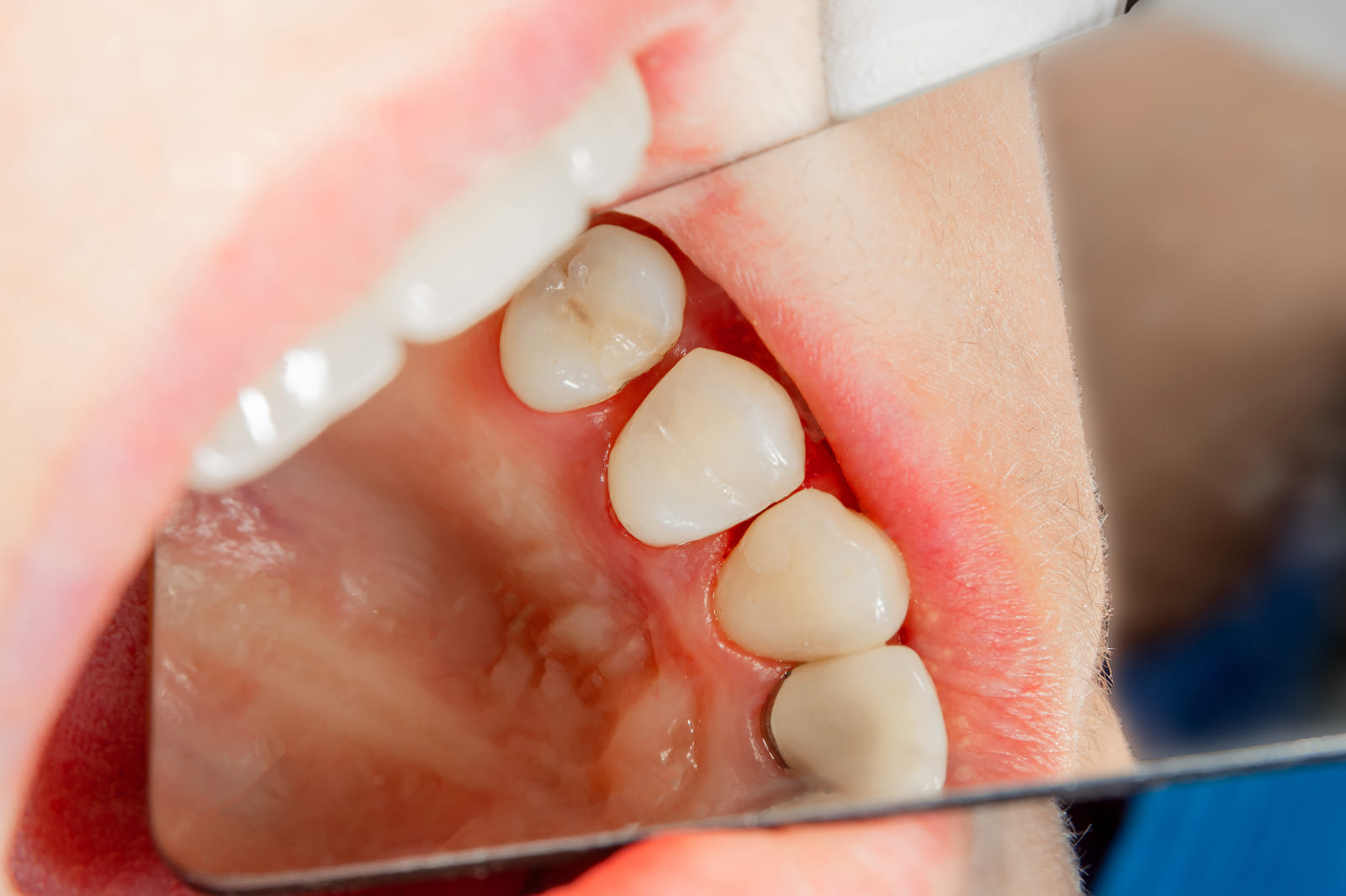 Child’s teeth with dental carries