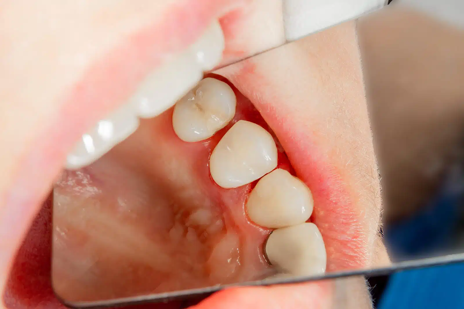 Child’s teeth with dental carries