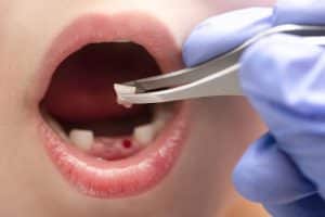 after tooth extraction