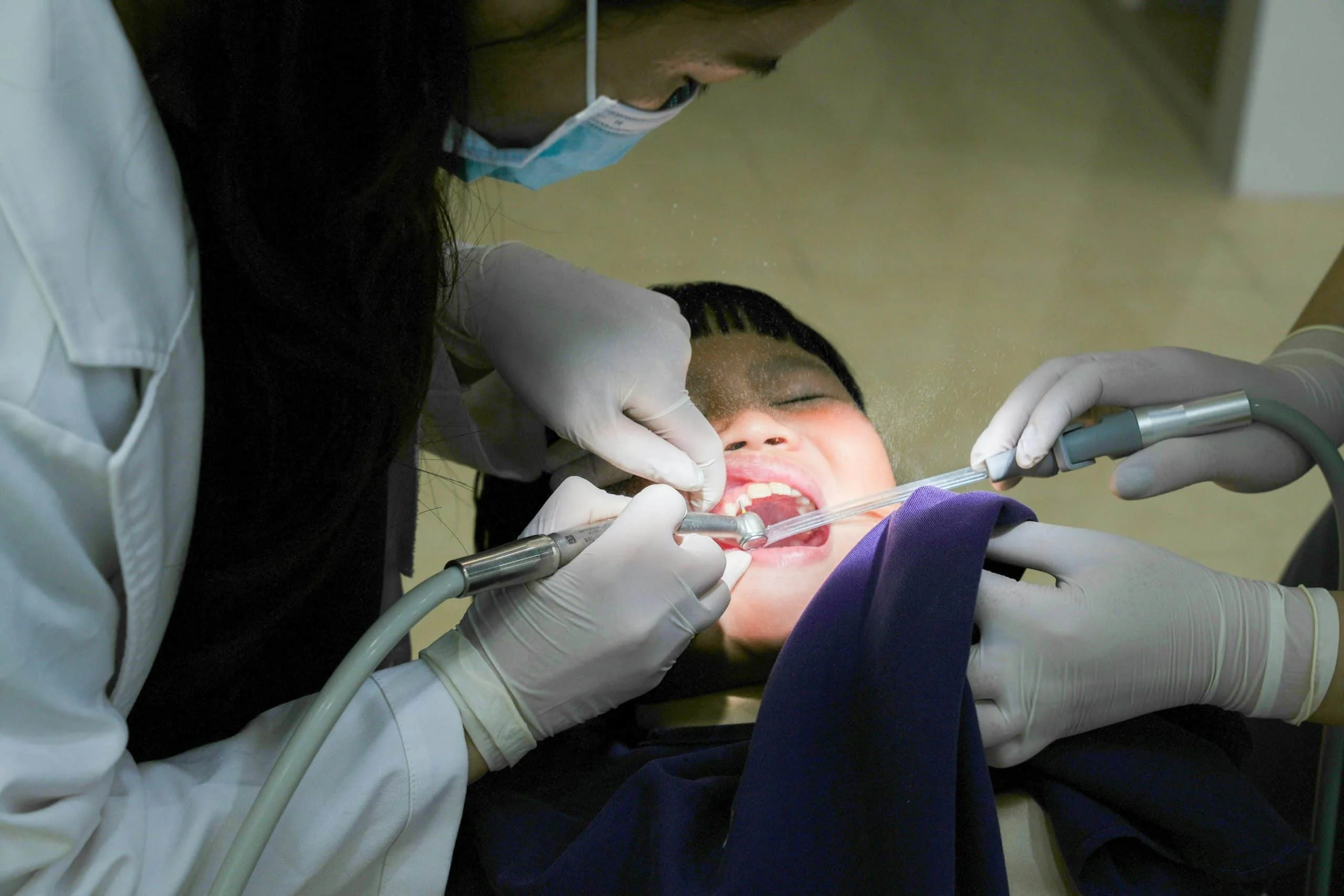 Kids Cavity Filling Benefits: Why Early Treatment Matters Most