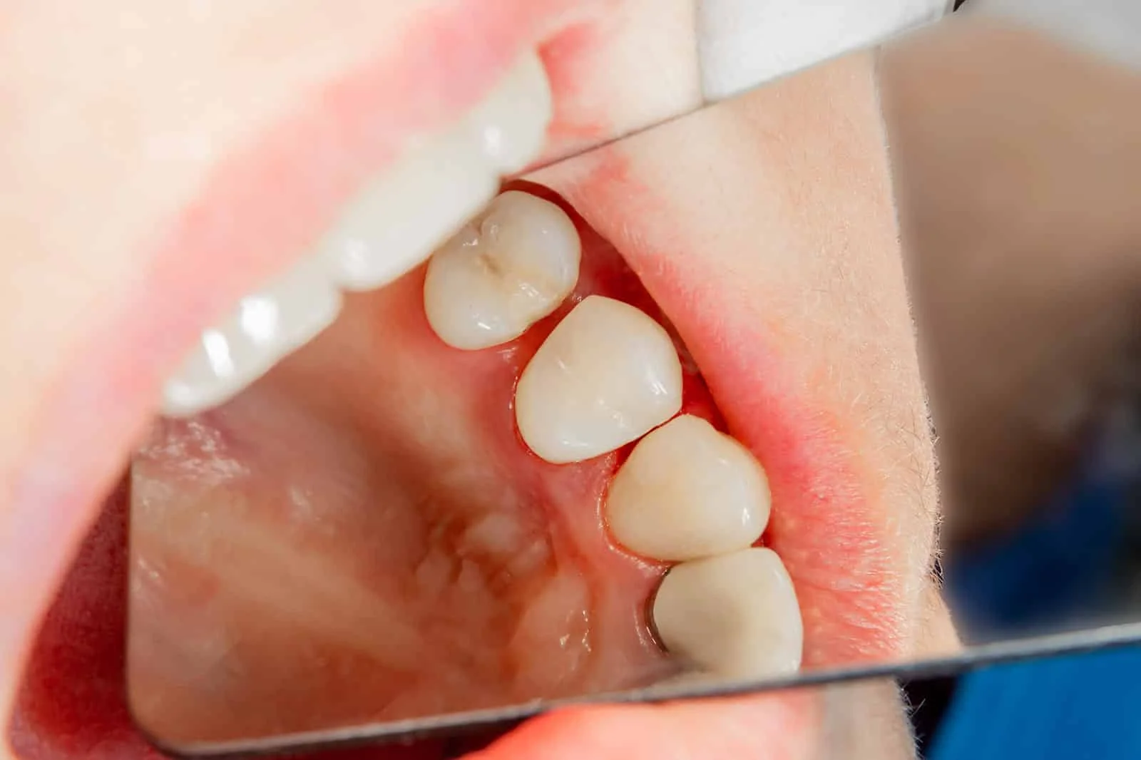 Child’s teeth with dental carries