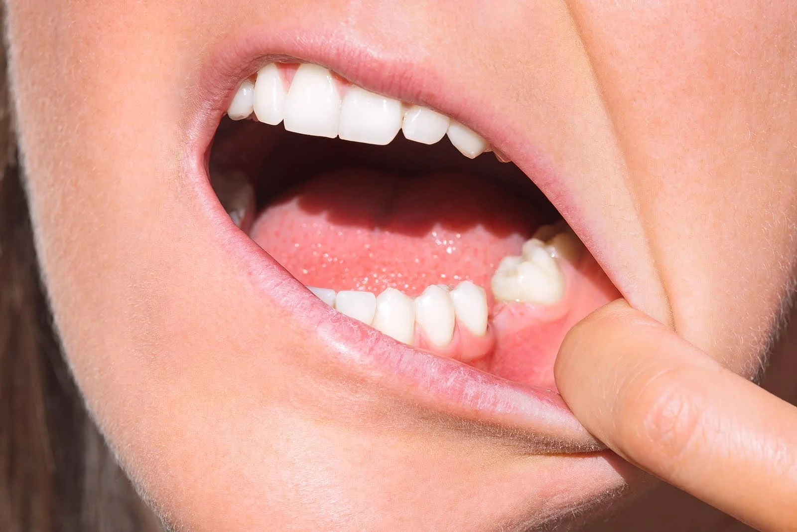 eat after tooth extraction